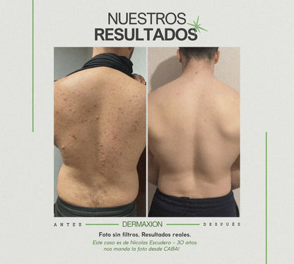 DermaXion® Gel Exfoliante Anti-Acné Pro