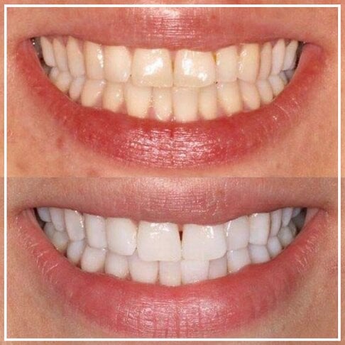 Smile White™ — El Lápiz Blanqueador 4X Más Potente