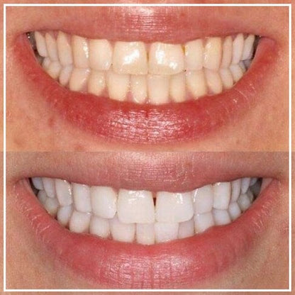 Smile White™ — El Lápiz Blanqueador 4X Más Potente