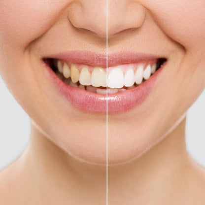 Smile White™ — El Lápiz Blanqueador 4X Más Potente (Promo 2x1)